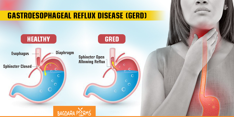 Effects of curcumin on reflux , Gastroesophageal reflux disease ,
