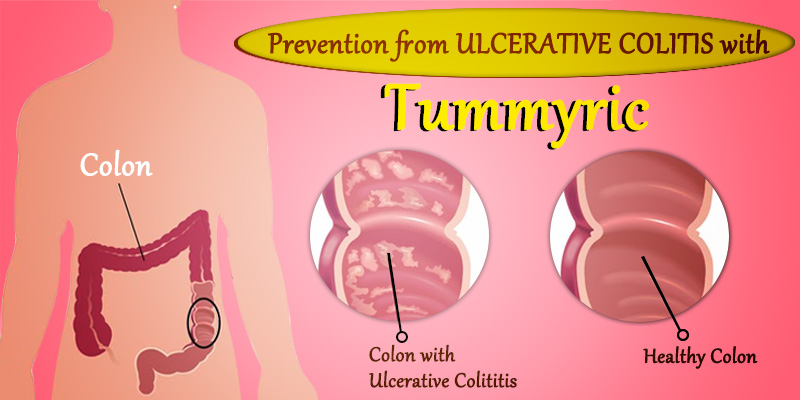 Ulcerative Colitis patients find relief with Tummyric