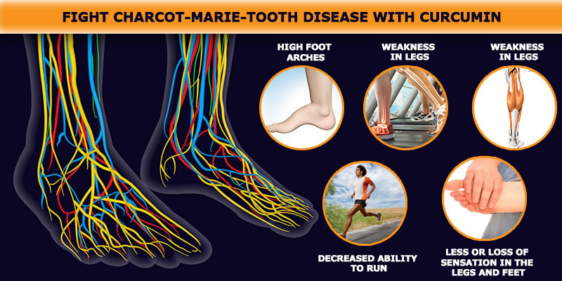 Charcot-Marie-Tooth disease , charcot disease ,