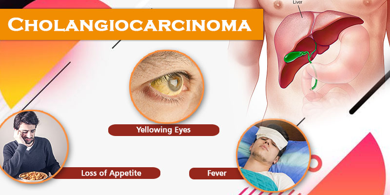 Oncomin to treat Cholangiocarcinoma